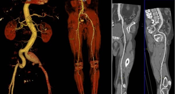 Αξονική Αγγειογραφία (CTA)