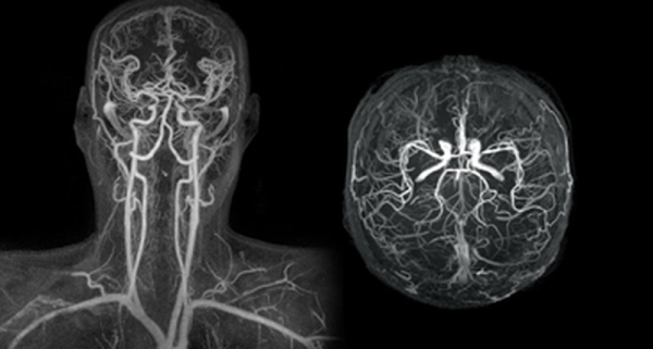 μαγνητική αγγειογραφία